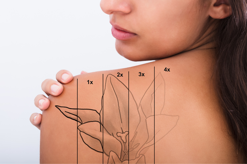 Tattoo Removal Pricing in Spring Branch, Texas