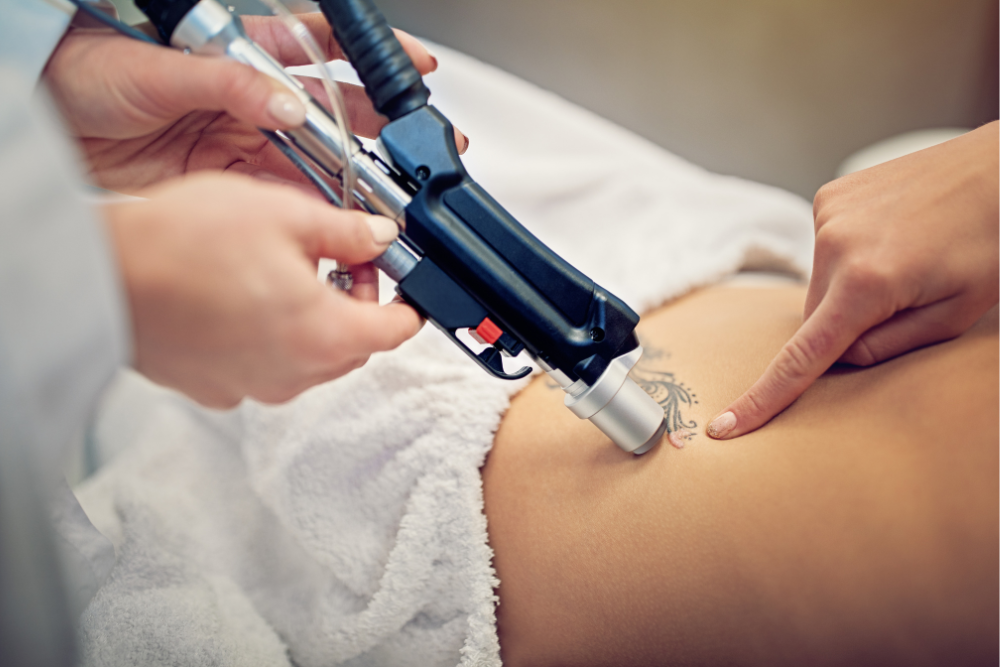 Stone Oak Tattoo Removal Pricing Guide