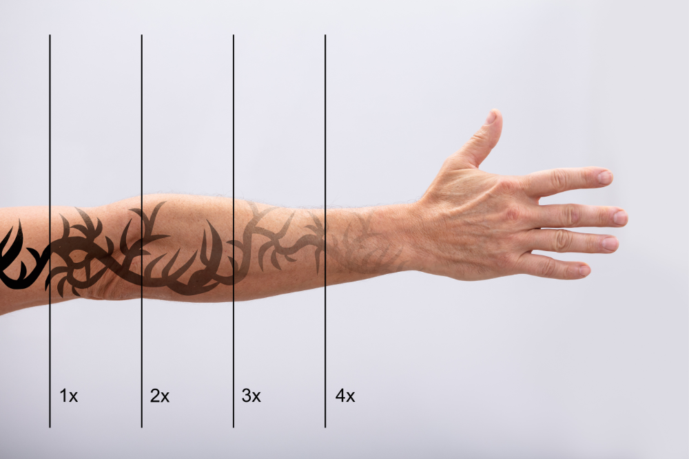 Tattoo Removal in Alamo Heights