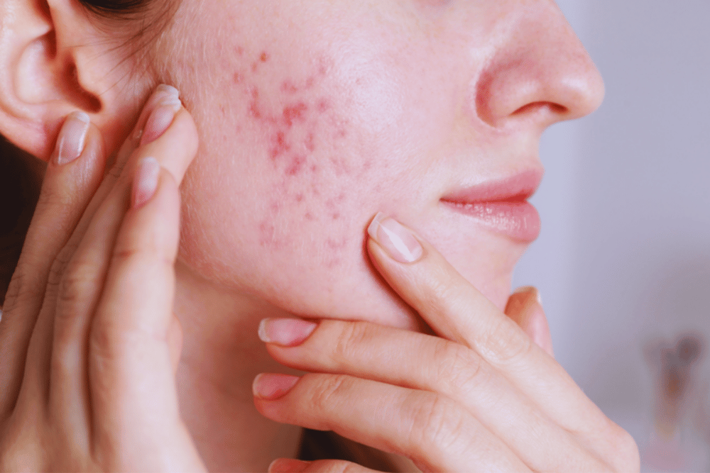 Acne Laser Treatment in Bulverde Texas