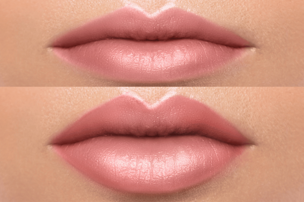 Lip Filler Pricing Guide in Spring Branch TX